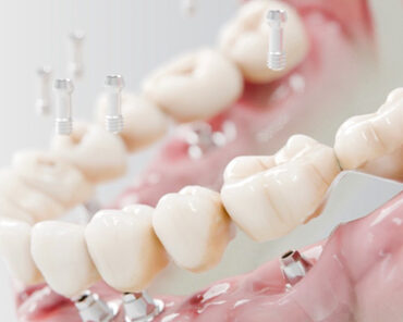 Tam Dişsizlikte İmplant Çözüm Müdür? | Aydı ...