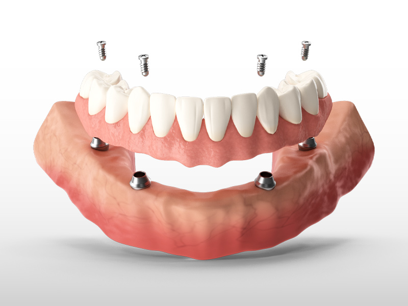 All-On-4-Dental-Implants-Phoenix-AZ