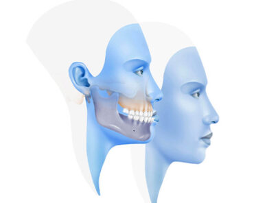 Alt ve Üst Çene Geriliğinin Tedavisi Nedir? | Ay ...